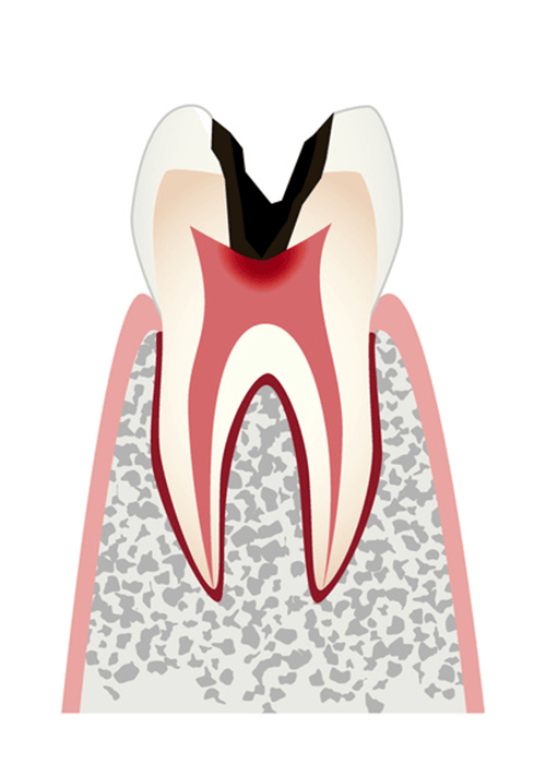 歯髄（歯の神経線維）まで進行したむし歯