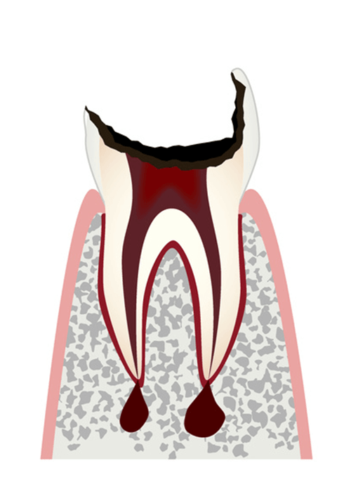 ほとんどの歯質が失われた歯